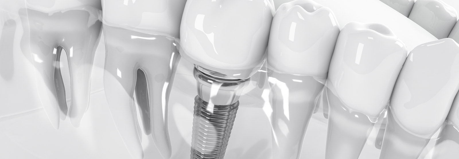 Top 5 beneficii ale implanturilor dentare moderne