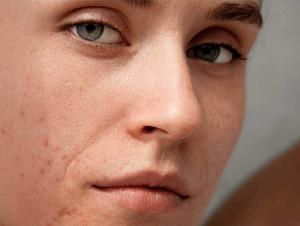 Tratamente anti-acnee